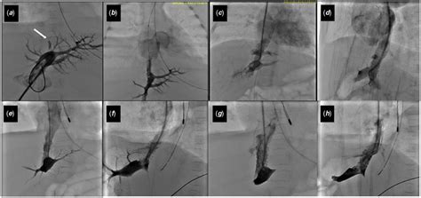 A Portal Vein Angiogram Demonstrating A Severely Stenotic Venous Duct