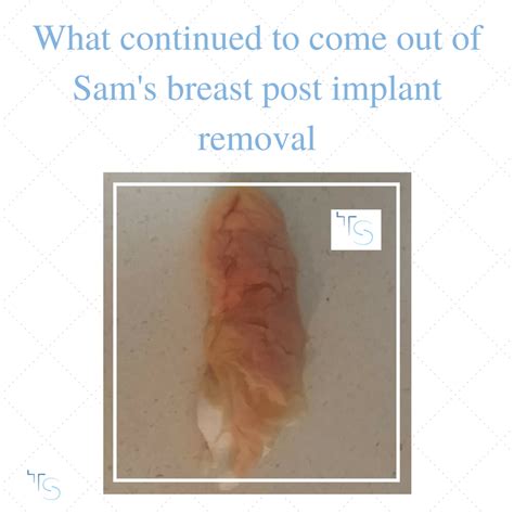 Samantha S Boob Job Horror Story Is A Warning To Other Women