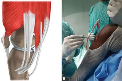 Les O Do Ligamento Cruzado Anterior Dr Victor Salas