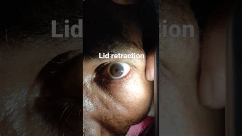 Lid Retraction And Pupillary Hippus Youtube