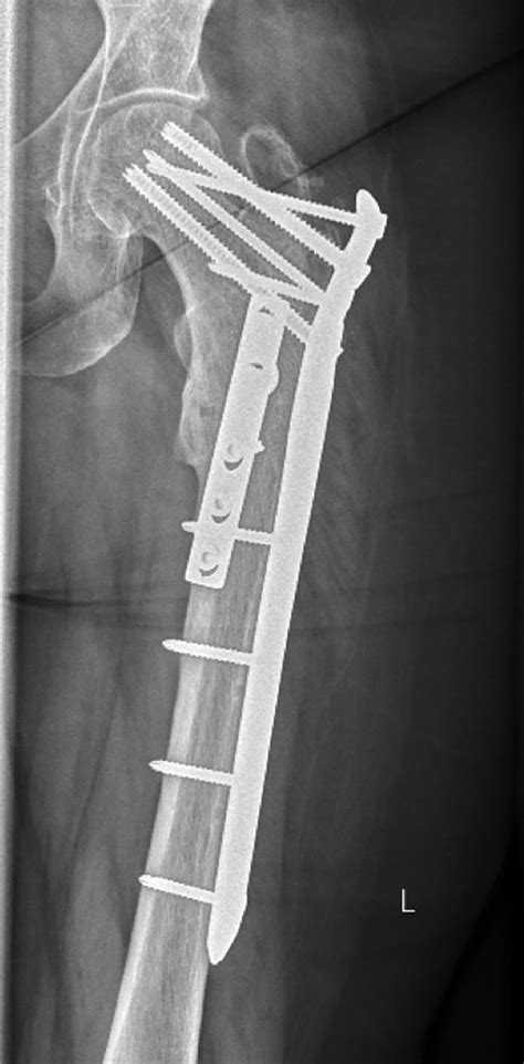 Subtrochanteric Fractures Of The Hip Orthopaedics And Trauma