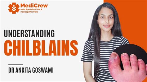 Understanding Chilblains With Dr Ankita Goswami Medicrew Homoeopathy