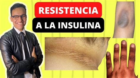 ¿tienes Resistencia A La Insulina Síntomas Diagnóstico Tratamiento Y Alimentación Youtube