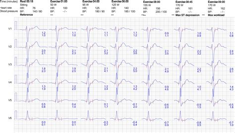 Evaluation Of Exercise Stress Test Ecg Symptoms Blood Pressure