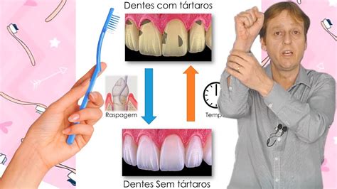 Placa Bacteriana E T Rtaro Qual A Diferen A Entre Um E Outro Youtube