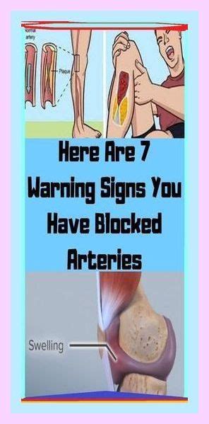 Here Are 7 Warning Signs You Have Blocked Arteries Betty Knight Artofit