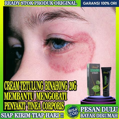 Jual Obat Tinea Corporis Salep Obat Eksim Kulit Gatal Selangkangan