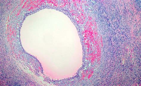 Pathology Outlines Polycystic Ovary Disease