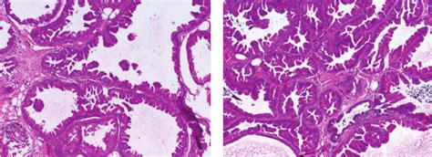 Representative Examples Of Mri Guided Breast Needle Core Biopsies