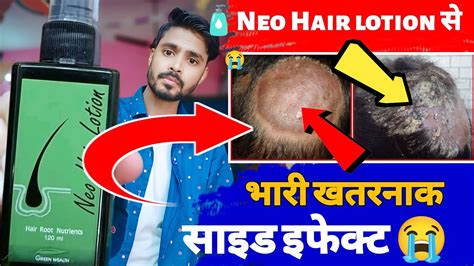 Neo Hair Lotion Side Effects Neo Hair Lotion Original And Fake Hair