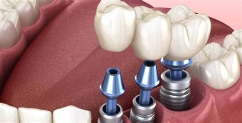 Dental Implant Failure Signs Causes And Treatment ILAJAK Medical