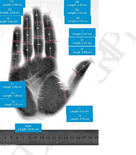 Figure 1 From Estimation Of Stature From Handprint Dimensions In