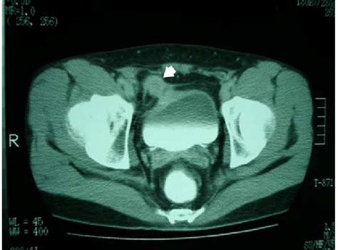 Lower Abdominal Ct Scan Showing An Isodense Lesion In The Upper