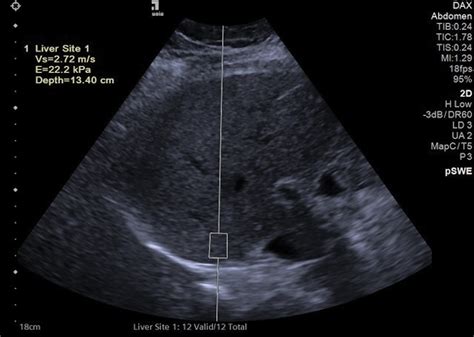 Protocols For Liver Stiffness Acquisition Radiology Key