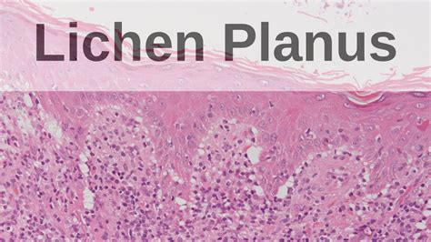 Lichen Planus Pathology Mini Tutorial Youtube