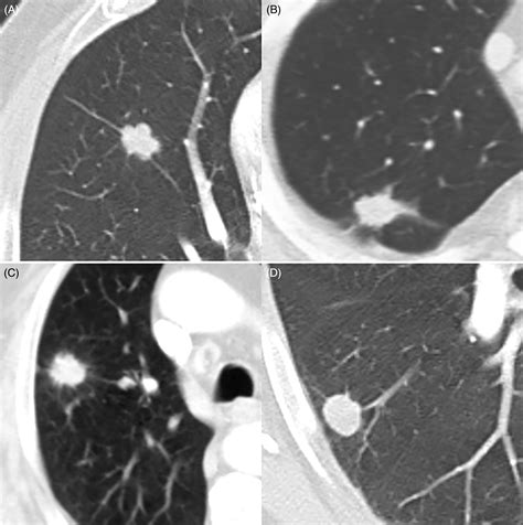 Ground Glass Opacity In Lungs Mayo Clinic Glass Designs