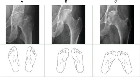 Preoperative Planning Of Total Hip Arthroplasty Intechopen