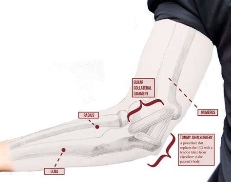 Tommy John Surgery (UCL Injury) - Motus Physical Therapy