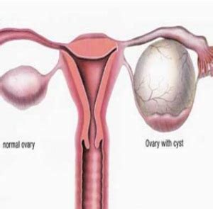 Adnexal Cyst – Location, Symptoms, Diagnosis, Types