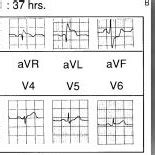 A ECG From Case 3 Recorded Two Hours After The Onset Of Chest Pain