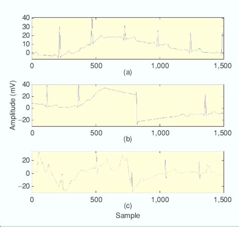 Standard ECG features: (a) wandering baseline, (b) motion artifact, and ...