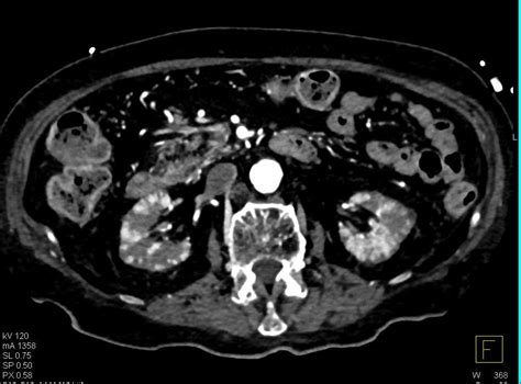 Poor Renal Function With Abnormal Renal Enhancement Kidney Case