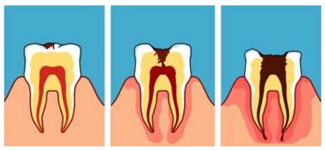 Caries Dentaltodo Lo Que Necesitas Saber Dentsanzpastor Burgos