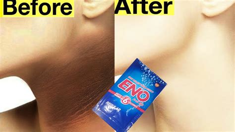 How To Get Rid Of Dark Neck With Eno Neck Blackness Remove Tips