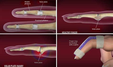 Volar Plate Injury Jammed Fingers And Avulsion Fractures Macomb Hand