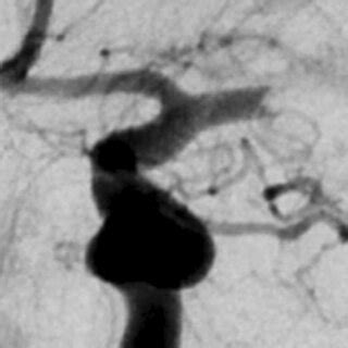 Example Of The Angiographic Meniscus Sign In A Patient With An M1