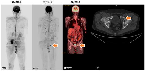 Hemato Free Full Text Diffusion Weighted Mri—the Way Forward For