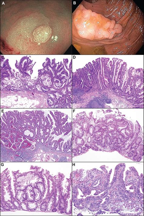 An Update On The Morphology And Molecular Pathology Of Serrated