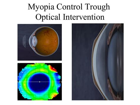 Orthokeratology Power Point Presentation