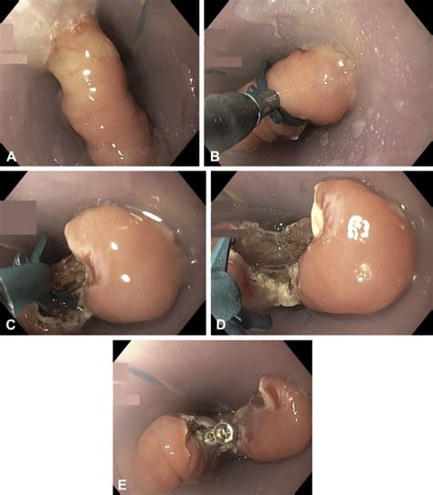 Novel Endoscopic Scissors For The Treatment Of Zenkers Diverticulum