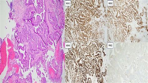 Invasive Moderately Differentiated Adenocarcinoma With Download Scientific Diagram