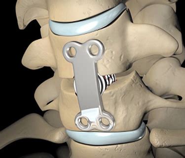 Texas Health Spine Orthopedic Center A Comprehensive Guide To Spinal