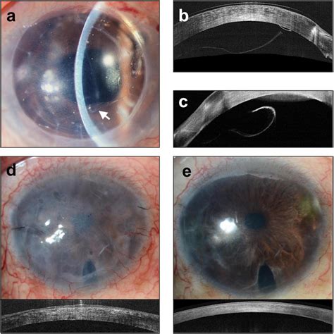 Complications Of Descemet Membrane Endothelial Keratoplasty Dmek A