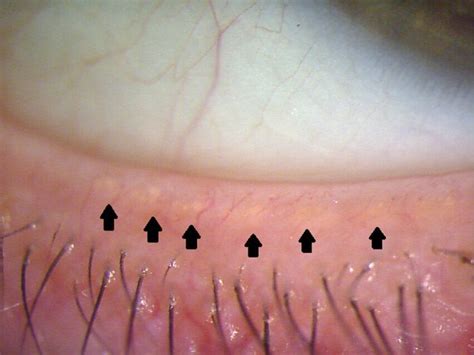 Understanding Meibomian Gland Dysfunction & Dry Eyes