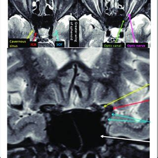 Diagrammatic representation of the right superior orbital fissure with ...