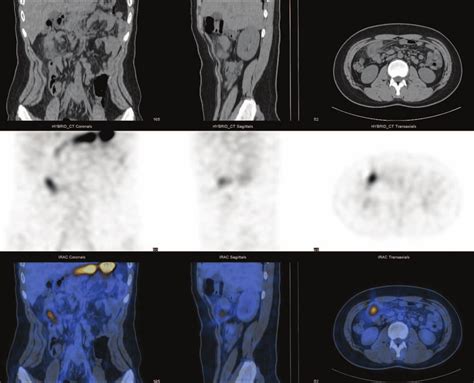 SPECT CT Fusion Imaging Obtained With 99m Technetium Pertechnetate Top