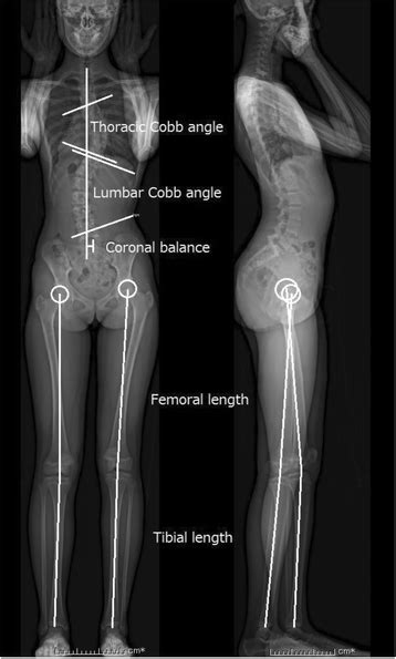 Evaluation Of Functional And Structural Leg Length Discrepancy In