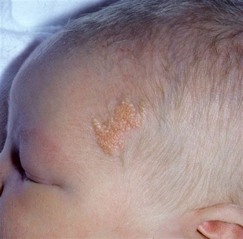 Epidermal Nevus Newborn