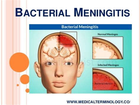 Bacterial Meningitis