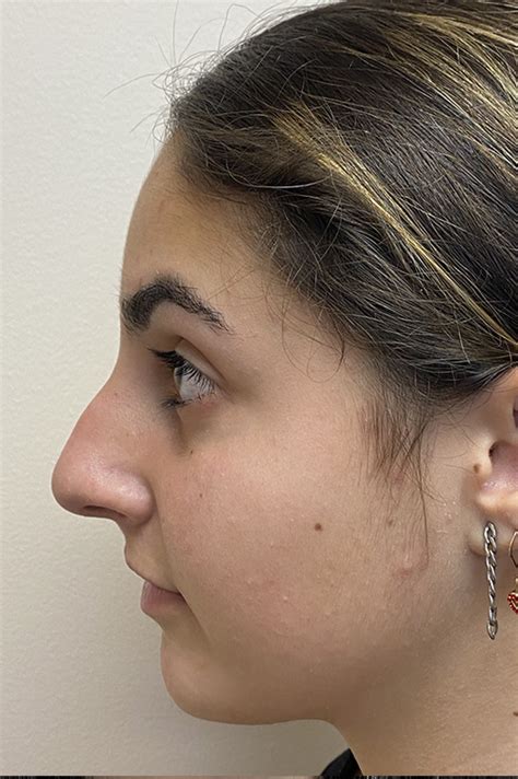 Los Angeles Rhinoplasty Before After Photos Patient 02 Dr Aminpour