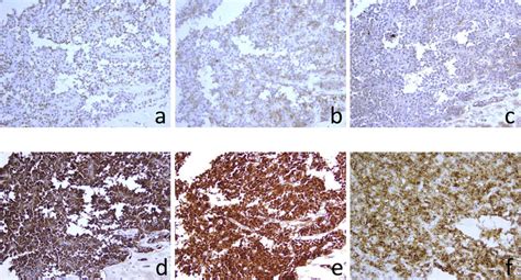 On Immunohistochemical Examination The Tumor Cells Are Weakly Positive