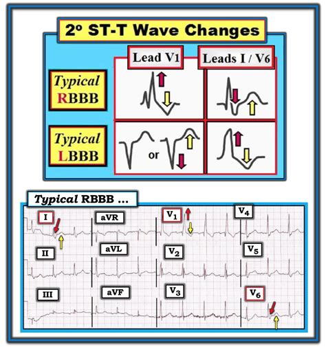 Dr Smith S Ecg Blog Two Patients With Rbbb