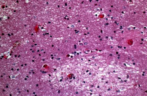 Plasmodium Falciparum Malaria Cerebral Malaria Wellcome Collection