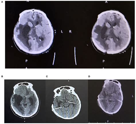 A Axial Plane Ct Head Showing Multiple Loculations In The Ventricle