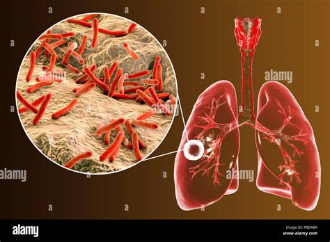 Tuberculosis Pulmonar Cavernoso Fibrosas Y Vista Cercana De