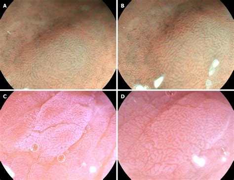 Figure From Comparison Of White Light Endoscopy Optical Enhanced And